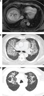 Radiation pneumonitis following Yttrium-90 radioembolization: A Korean multicenter study